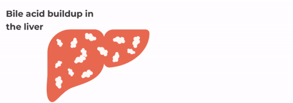 Animation of a liver with bile acids building up inside it, and then spilling out from the liver into the bloodstream.