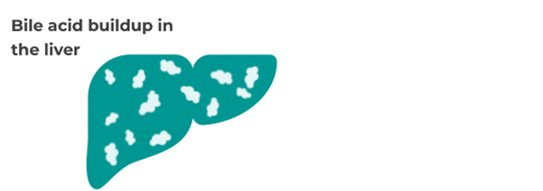 Animation of a liver with bile acids building up inside it, and then spilling out from the liver into the bloodstream.