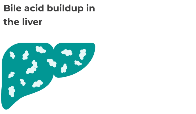 Animation of a liver with bile acids building up inside it, and then spilling out from the liver into the bloodstream.