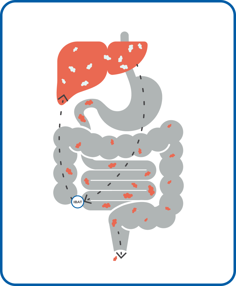 Diagram of normal circulation of bile acids. Bile acids flow from the liver to the small intestine, where they are recycled by the IBAT.
