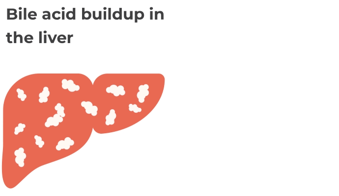 Animation of a liver with bile acids building up inside it and then spilling out from the liver into the bloodstream.
