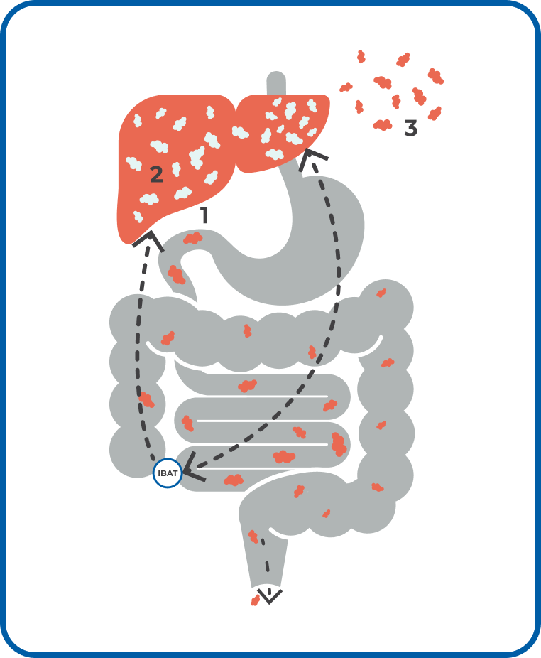 Diagram of flow of bile acid in person with Alagille syndrome. Bile acids build up in liver and spill out into bloodstream.